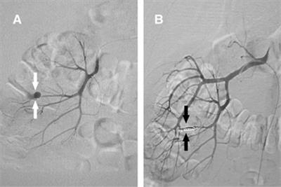 Renal Pseudoaneurysms after Flexible Ureteroscopy and Holmium Laser Lithotripsy: A Case Report